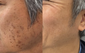 雀斑、黃褐斑、老年斑？ 皮秒一掃光！