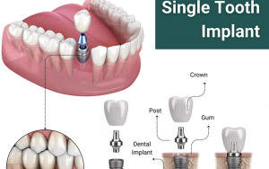 大天使植牙專科 周啓誠醫生專欄 36 – 單顆牙齒替換！