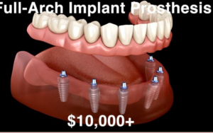 大天使植牙專科 周啓誠醫生專欄 16條 –植牙的價格