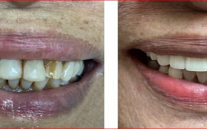 大天使植牙專科 周啓誠醫生專欄18——向美麗新笑容的轉變！