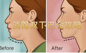 溶脂針快速消除雙下巴 和羊腮 奧斯丁NeoSoma專業醫美幫您養成側顔殺