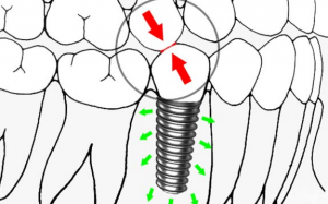 大天使植牙專科 	 周啓誠醫生專欄 37 - 種植牙醫學中的生物力學！