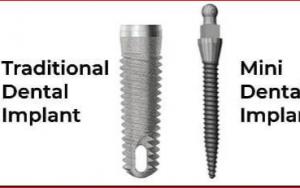 大天使植牙專科 周啓誠醫生專欄 35 - 可用的牙種植體有哪些類型？