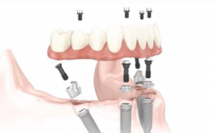 大天使植牙專科 周啓誠醫生專欄22——All-on-4到底是什麽？